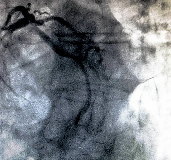 Catheterisatie Cardiale Ventriculography Een Medische Beeldvorming Test Gebruikt Bepalen Een — Stockfoto