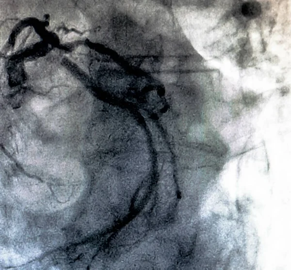 カテーテル検査 心臓造影は右または左心室における患者の心機能を決定するために使用するイメージング検査です — ストック写真