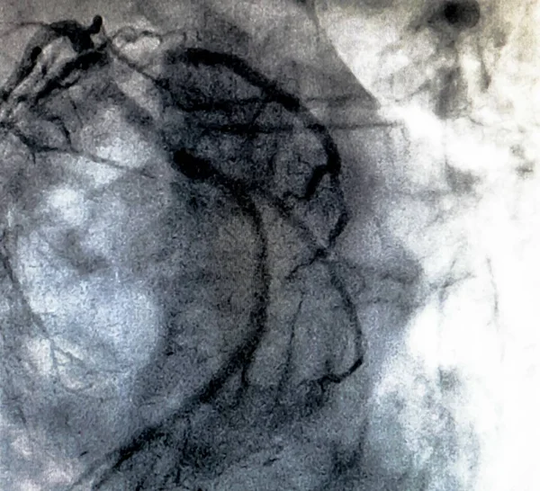 Katetrizace Srdeční Ventrikulografie Lékařská Zobrazovací Test Slouží Určení Pacienta Srdeční — Stock fotografie