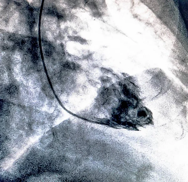 Katéterezés Szív Ventriculographia Egy Orvosi Képalkotó Vizsgálat Segítségével Meghatározható Egy — Stock Fotó