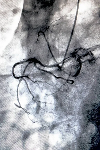 Cateterismo Ventriculografía Cardiaca Una Prueba Imagen Médica Utilizada Para Determinar — Foto de Stock