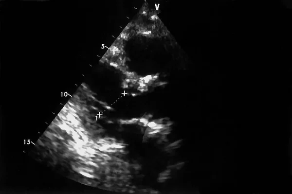 Images D Echographie Cardiaque Ecran De La Machine D Echo Cardiographie Echos Doppler Sang Superficie Stock Photo Images D Echographie Cardiaque Ecran De La Machine D Echo Cardiographie Echos Doppler Sang Superficie Stock Photo