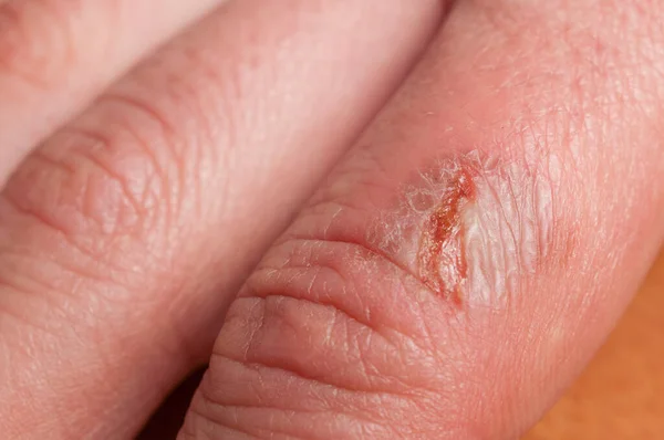 Detail Van Geïnfecteerde Brandwonden Vinger Van Een Vrouw Stockafbeelding