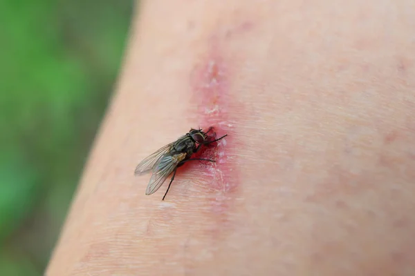 Fly Muscidae on healing wound on injured human body skin surface closeup view with copy space for text. Threat of infection and healthcare concept.