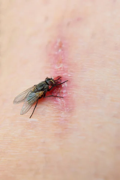 Fly Muscidae on healing wound on injured human body skin surface closeup view. Threat of infection and healthcare concept.