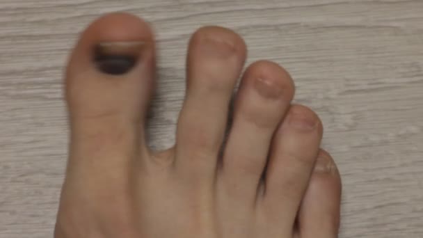 Unhas pretas, trauma nas unhas, perna masculina, close-up — Vídeo de Stock