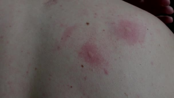 Мужчина расчесывает волдыри на теле от укуса комара, крупным планом, укуса комара — стоковое видео