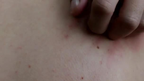 Un uomo graffia un blister da una puntura di zanzara, primo piano, pelle rossa, prurito, allergia — Video Stock