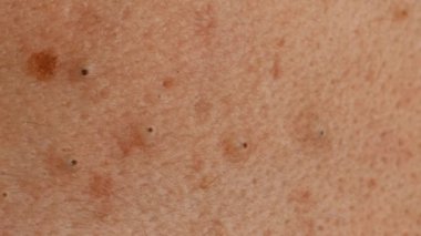 Sigara, bakımlı ve ditry erkek cilt ile acnes, makro