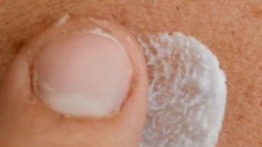 Sigara, bakımlı ve ditry erkek cilt ile acnes, makro