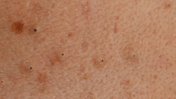 Nie przygotowanych i ditry męskiej skóry z acnes, makro — Wideo stockowe