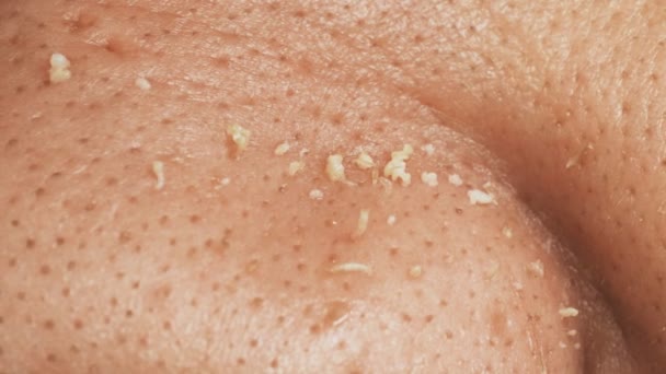 Pele masculina não tratada e ditry com acnes, macro — Vídeo de Stock