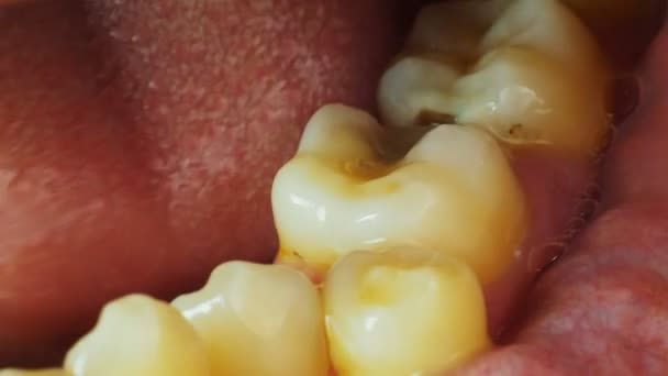 Bad and yellow mans teeth, a hole in the tooth, macro — Stock Video