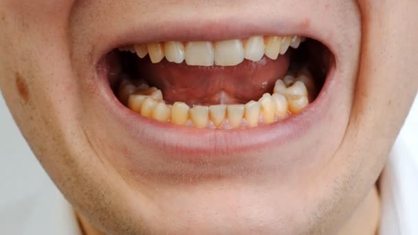 Bouche ouverte de Mans avec de mauvaises dents, dents tordues — Video