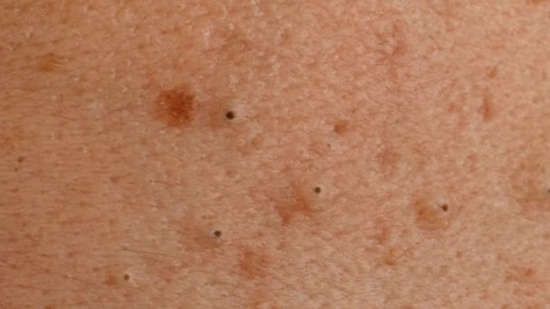 Kulit laki-laki tidak terawat dan ditry dengan acnes, makro — Stok Video