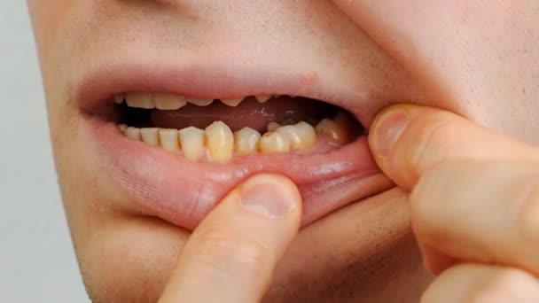 Погані і жовті зуби чоловіка, криві зуби — стокове відео