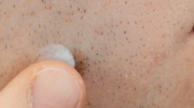 Doğum lekesi veya nevus üzerinde yüz cilt mans