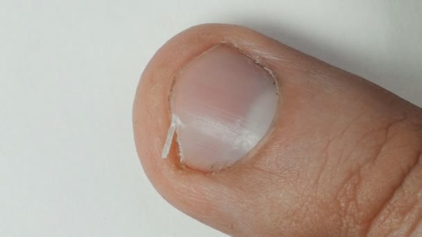 Unattended and broken nail, cracked skin, bad nail grooming — Stock Video