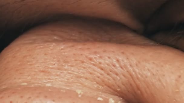 Non groomed and ditry male skin with acnes, macro — Stock Video