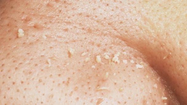 Pele masculina não tratada e ditry com acnes, macro — Vídeo de Stock