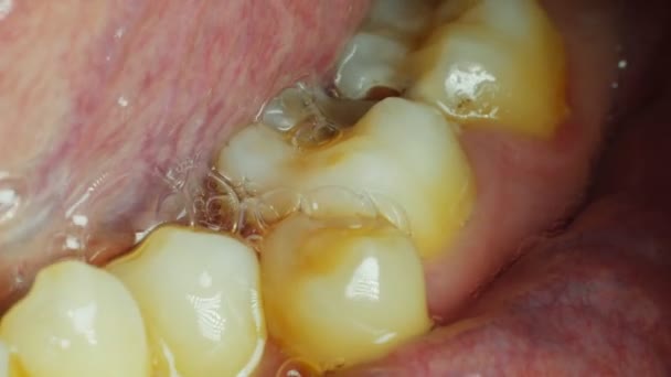 Bad and yellow mans teeth, a hole in the tooth, macro — Stock Video