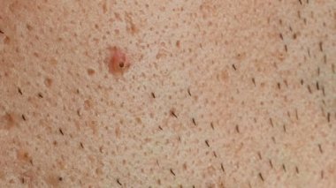 Sigara, bakımlı ve ditry erkek cilt acnes ve kıl, makro ile