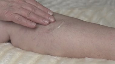 Kadın varis için şifa bir krem smear onun bacak, yakın çekim, ağır çekim, merhem