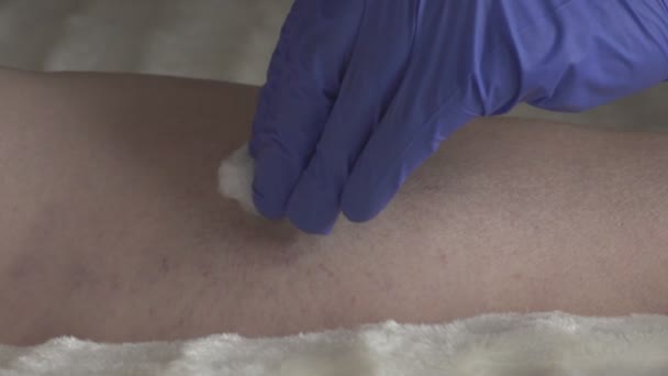 Läkare utför sclerotherapy för åderbråck på benen, åderbråck behandling, injektion, Slowmotion — Stockvideo