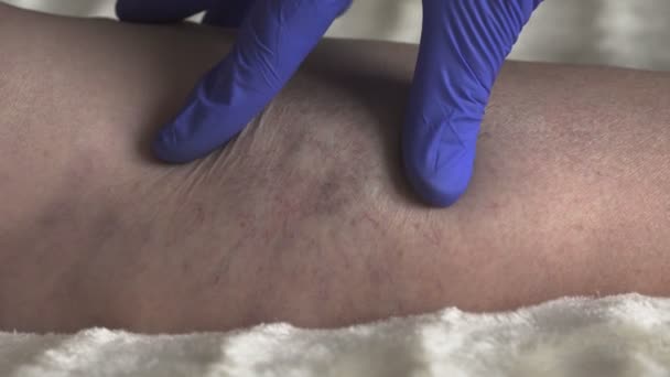 Médico examina as pernas de uma paciente feminina cujas varizes e tromboflebite — Vídeo de Stock