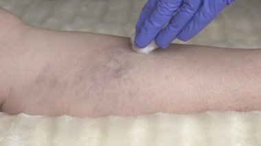 Doktor skleroterapi varis bacaklar, Varis tedavisi, enjeksiyon, ağır çekim için gerçekleştirir