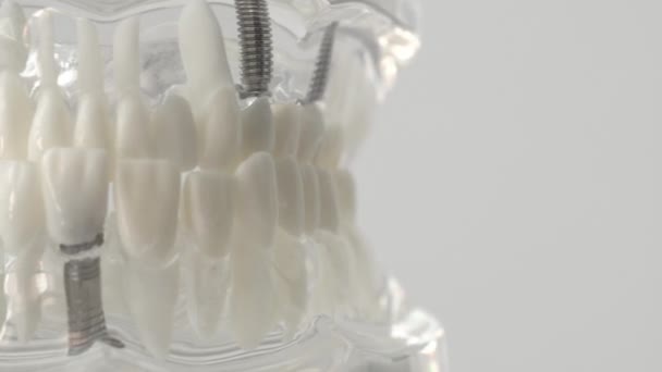 톱니 모양의 치아 이식편을 턱에 꽂는다. 치과, 치과, 치아 이식술에 대한 현대적 인 절차의 개념, 배경 — 비디오