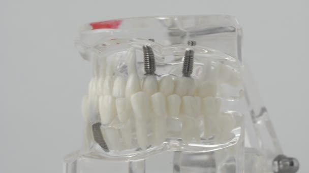 Implantes dentales en la mandíbula. Concepto de procedimiento moderno en odontología, implantes dentales, antecedentes — Vídeos de Stock