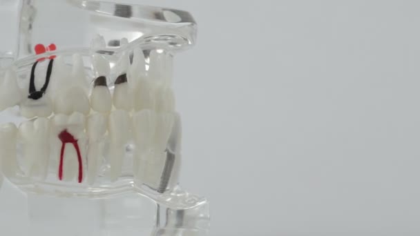 Layouten av den mänskliga käken på en vit bakgrund med dåliga tänder. Begreppet behandling av lunginflammation och karies inom tandvården, kopieringsutrymme — Stockvideo