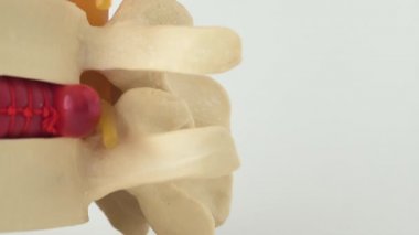 Doktor nörolog omurgasında omurgalar arası fıtık olduğunu söylüyor. Omurga hastalığı konsepti ve inzivaya çekilmesi veya orta bel fıtığı, omurilik segası, osteokondrosis, kopyalama alanı
