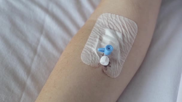 Intravenous catheter on the patients arm, close-up. Catheterization for injecting medication into a vein, bloodstream — Stock Video