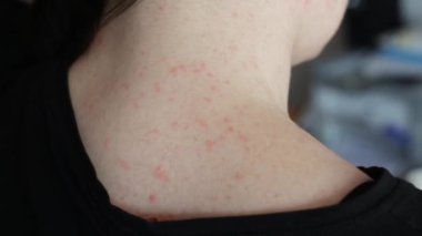 Kızların boynundaki deride kırmızı sivilce. Tahriş ve alerji konsepti, dermatoloji