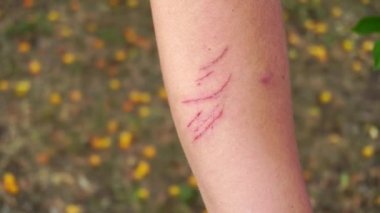 Bir adamın elinde kırmızı çizikler, yakın plan, deri hasarı.