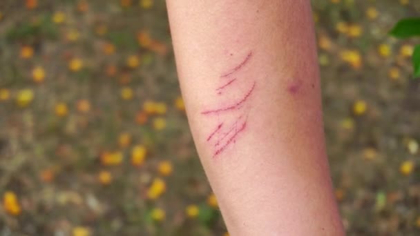 Rote Kratzer auf der Haut einer menschlichen Hand, Nahaufnahme, Hautschäden — Stockvideo