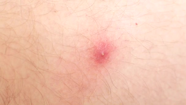 Красный прыщ кипит на коже, заднем плане, макро, дерматологии — стоковое видео