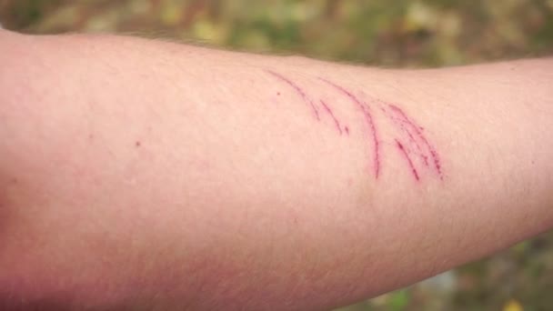 Rode krassen op de huid van een mensenhand, close-up, huidbeschadiging — Stockvideo