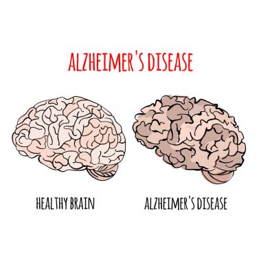 Alzheimer Hastalığı Hafıza Kaybı Beyin Hasarı Tıp Sağlık Tedavi Tedavi Afiş Poster Vektör İllüstrasyon