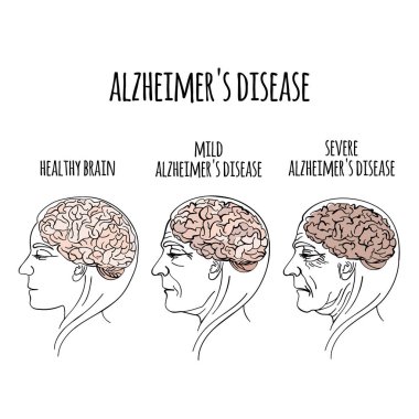 Demans Alzheimer Hastalığı Hafıza Kaybı Beyin Hasarı Tıp Sağlık Tedavi Tedavi Afiş Poster Vektör İllüstrasyon
