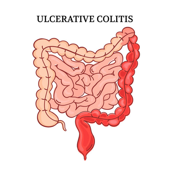 ULCERATIVE COLITIS Intestines Education Medicine Anatomy Scheme Human Handdraw Vector
