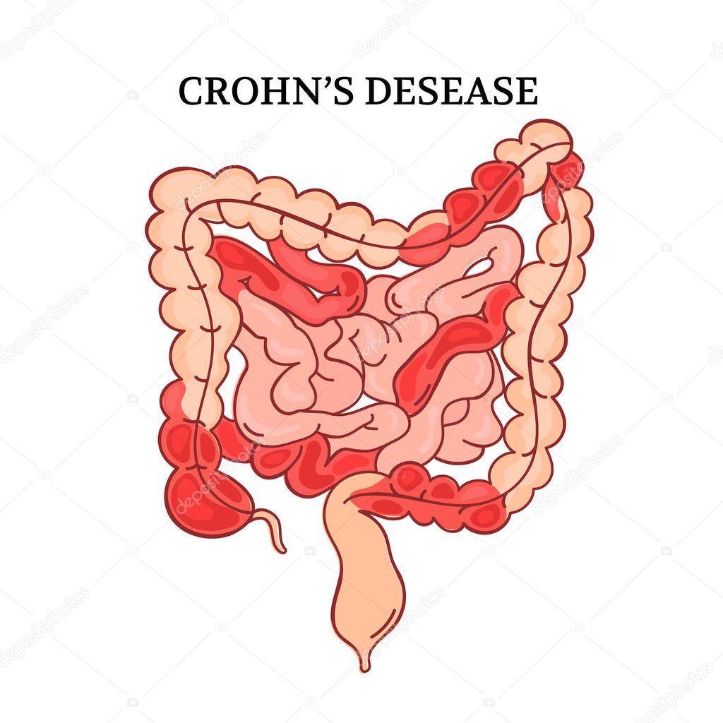 CROHN DESEASE Intestines Medicine Scheme Anatomy Human Handdraw Vector Illustration