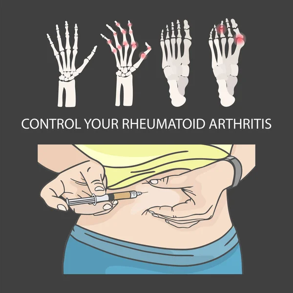 Rheumatoid Arthritis Control Hypodermic Injection Belomach Medical Human Dislness Vector — Stockový vektor