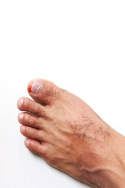 Çivi, kaza anlamaya çivi ayak ülseri Onychocryptosis bir çivi rakam ayak çivi, kanama travma,