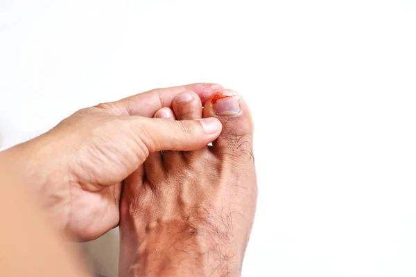 Uitzoeken Van Nagel Ongeval Nail Trauma Bloeden Teennagels Voet Ulcera — Stockfoto