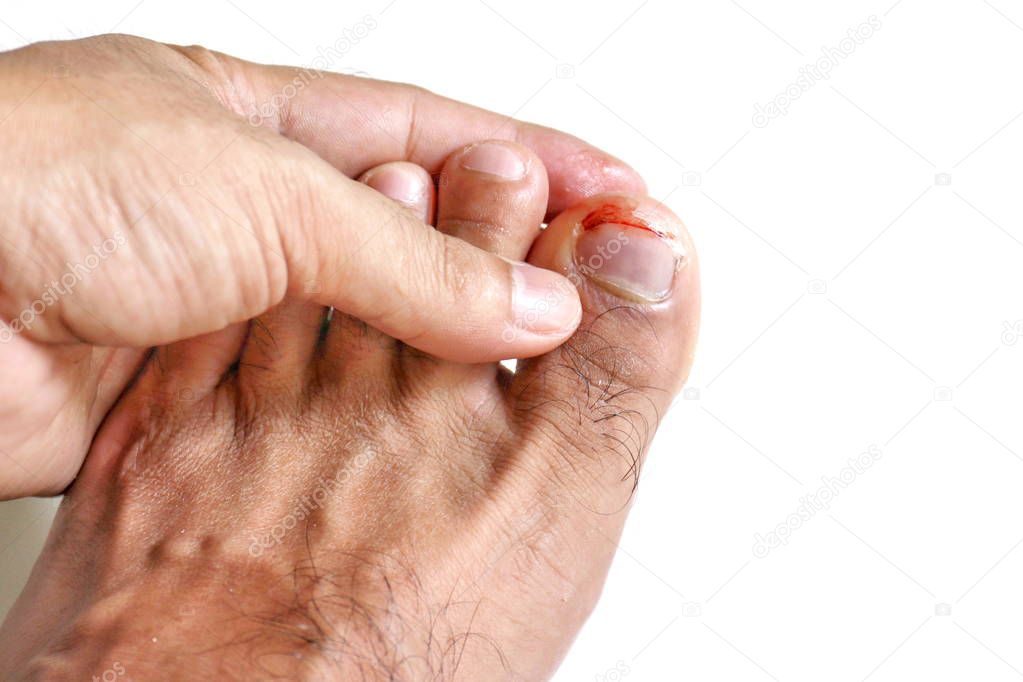 Figure out the nail, Accident nail trauma, bleeding toe nails, Foot ulcers figure out a nail, Onychocryptosis