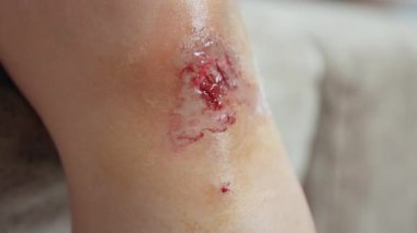 Diz yarası, dizimdeki taze yara bir kazadan, deri yarasından, yara bakımını temsil eden ilk yardım, ve kişisel sağlık, yakın çekim.