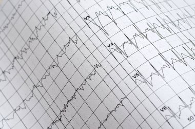 Elektrokardiyogram grafik olarak tıbbi geçmişi. Yakın çekim